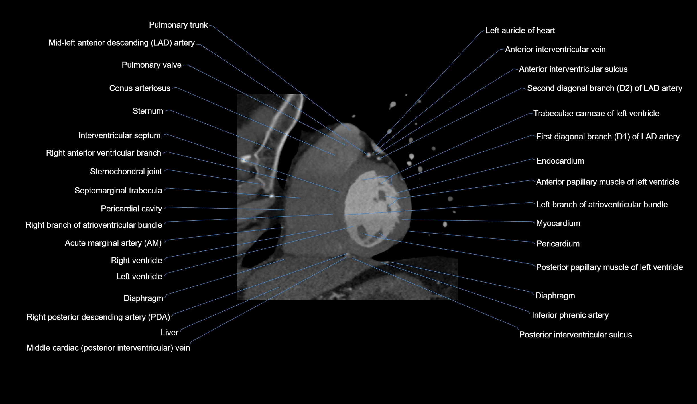 CT heart (coronary angiogram) short axis view  cross sectional anatomy labelled radiology image-00031.webp